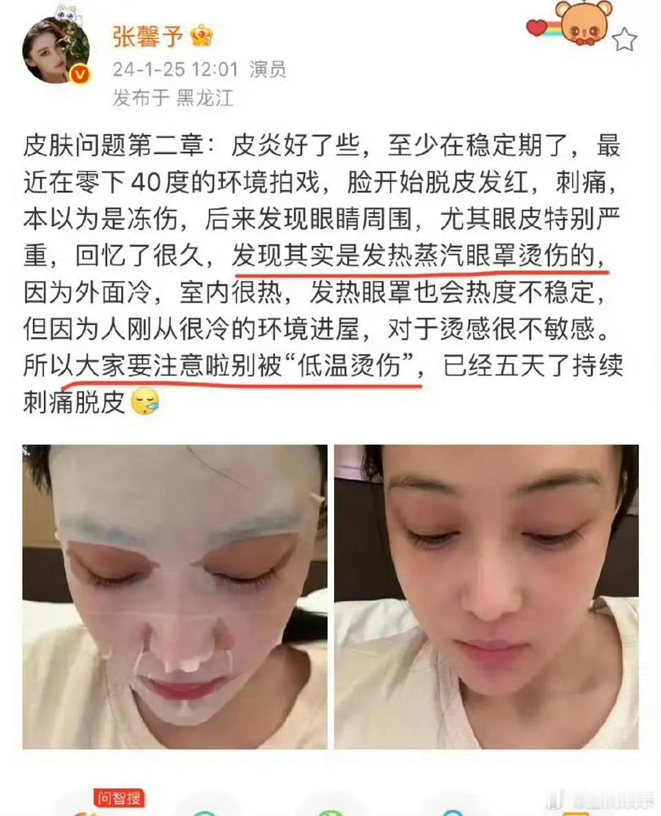 如果明星也能够被蒸汽眼罩烫伤，咱们就要更注意了‼️杨幂和张馨予都被烫伤了 