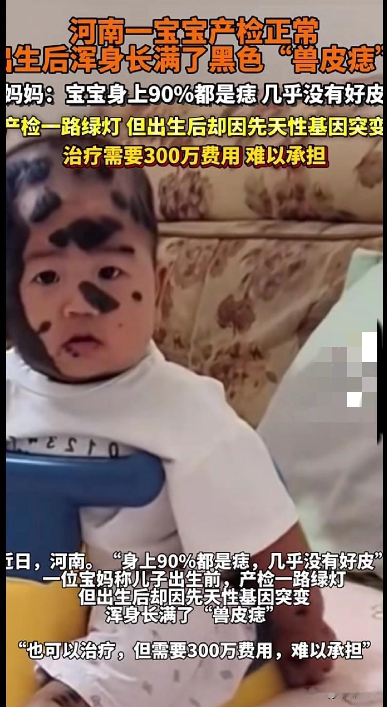 产检全绿灯的宝宝，生下来满身“兽皮痣”：300万治疗费压垮了爸妈
 
这宝宝的样