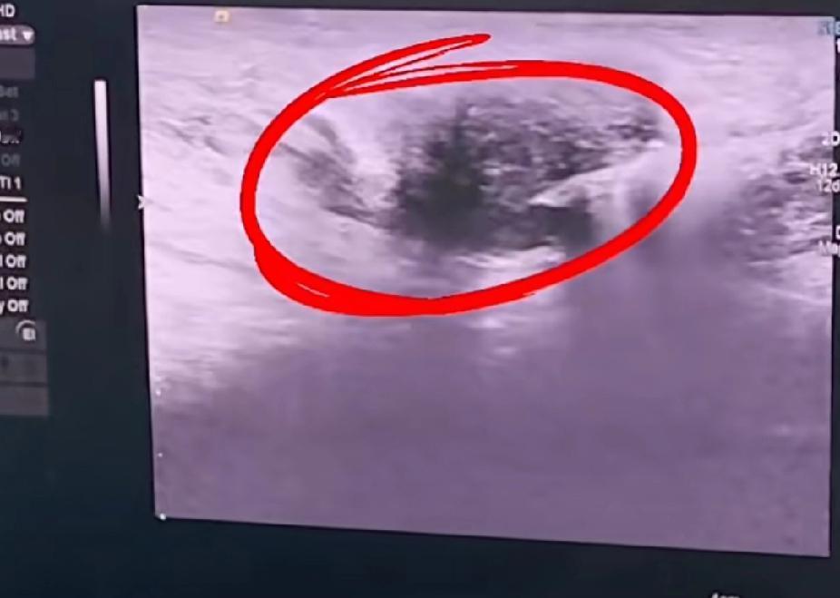 19岁女孩乳腺查出了上百个结节，医生从业26年，直骨罕见，近日河南省肿瘤医院超声