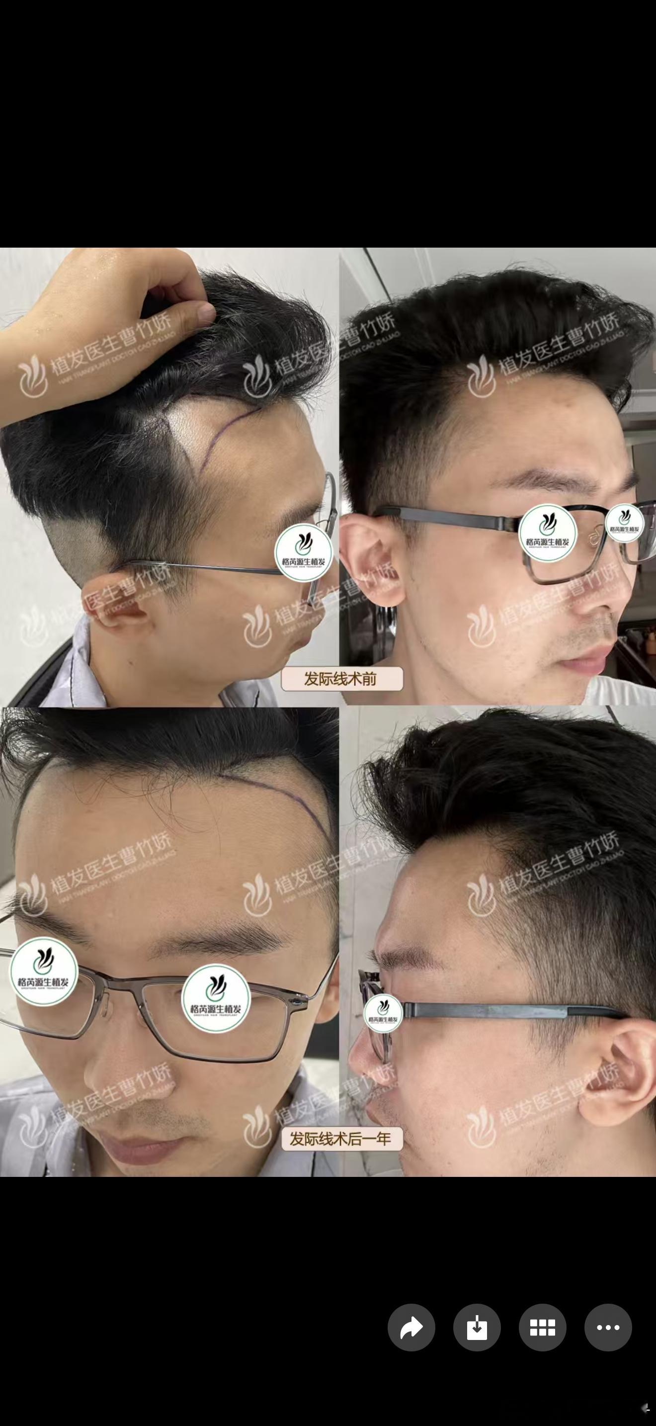 好吧，打算带男朋友做下发际线+眼睛+下巴手术，剩下就做做医美，有种养成系的快乐。