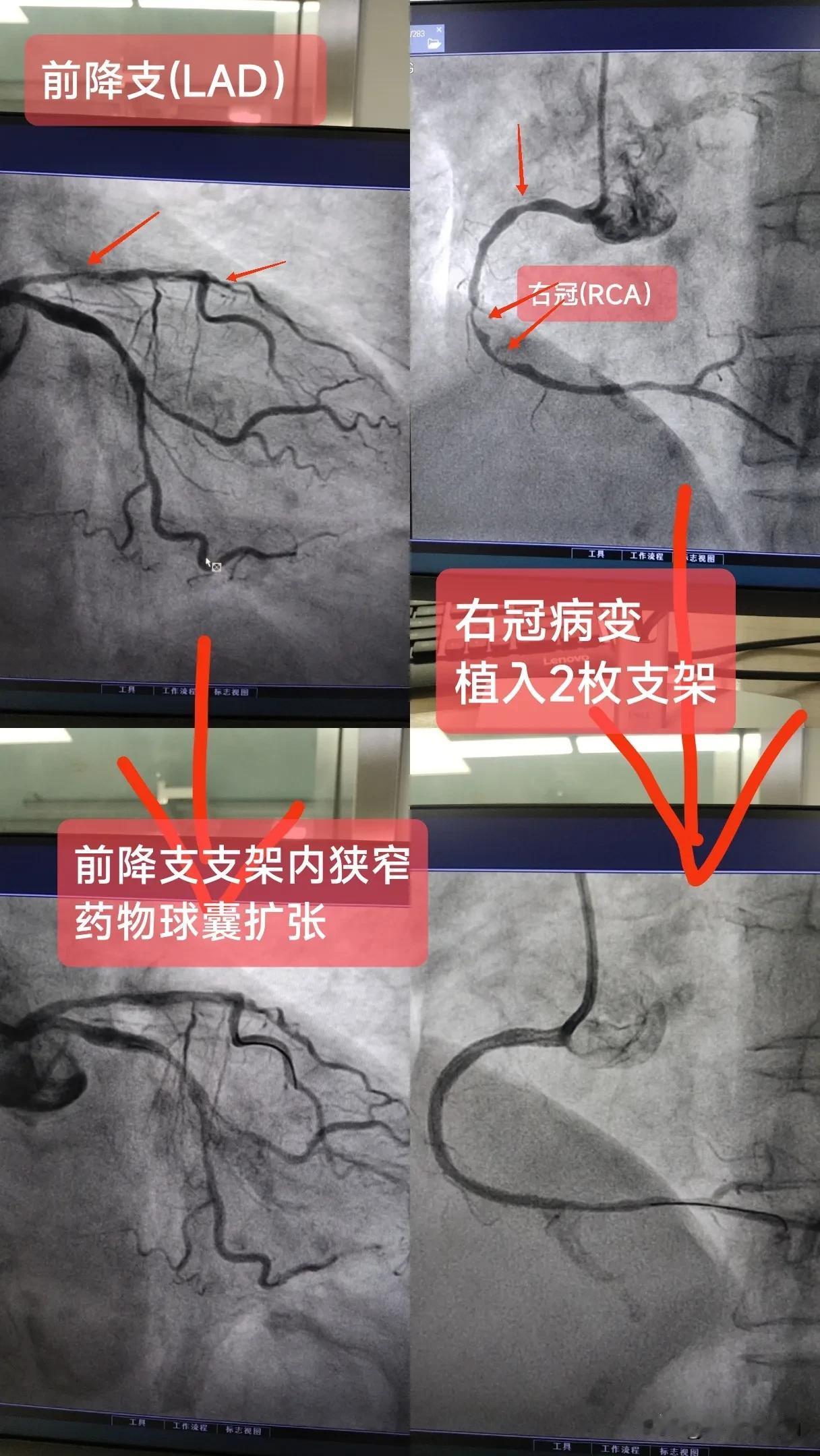 急性非ST段抬高型心肌梗死
(前降支支架内狭窄、右冠病变)

一.概念：
左前降