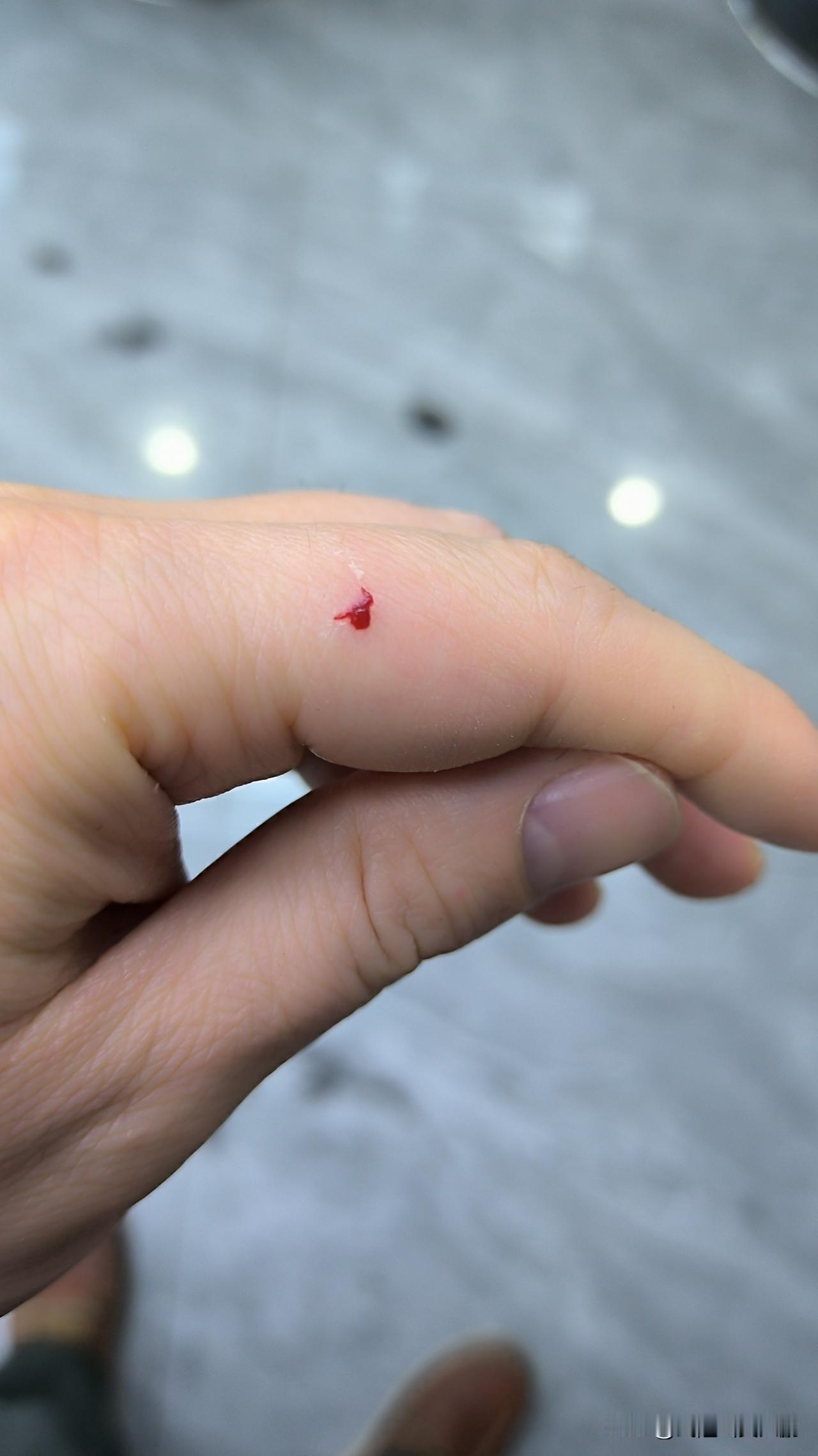 常在河边走，哪有不湿鞋？老师傅被剪刀咬到手！护理好多人都会被剪刀手吧