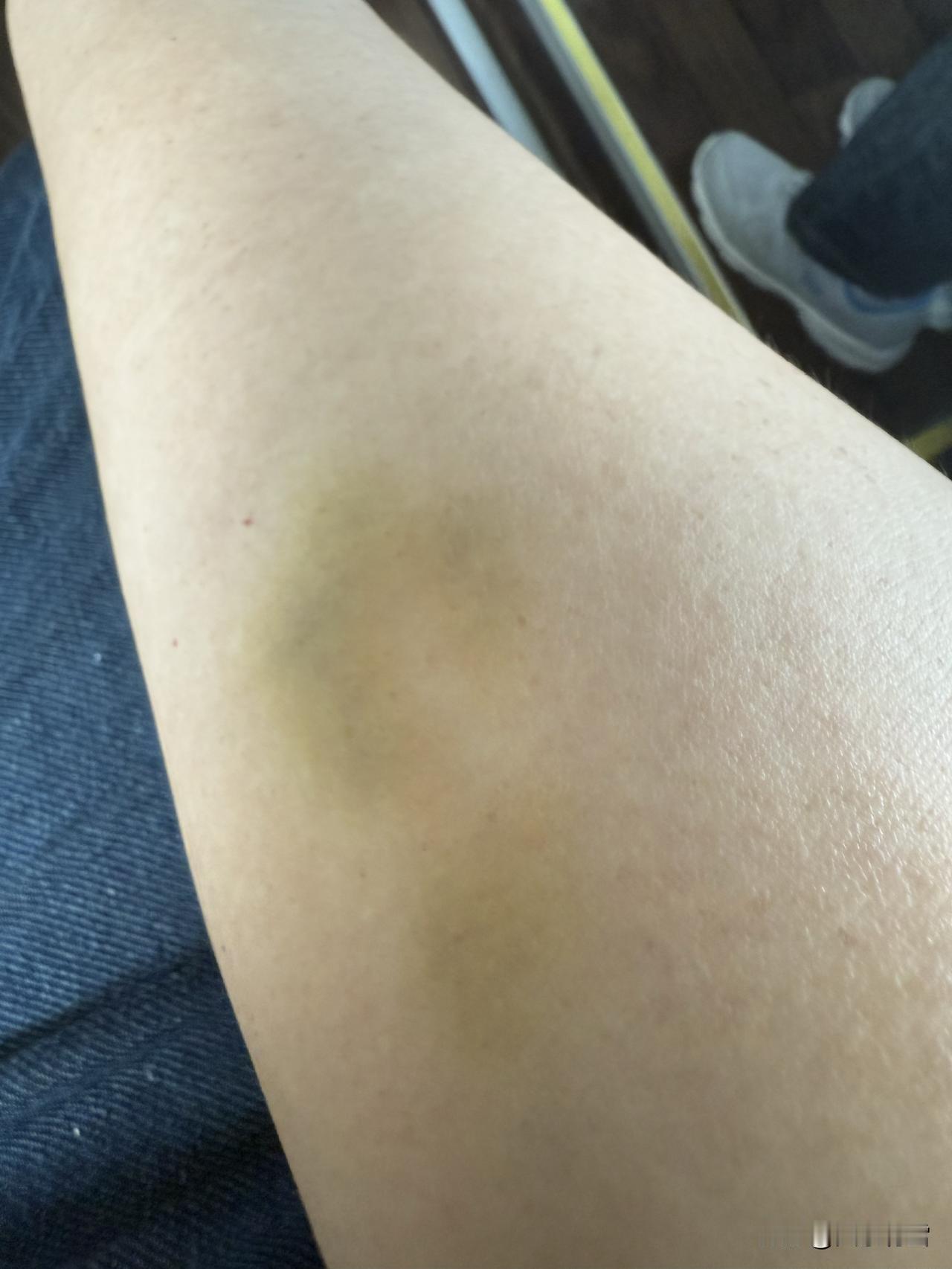 右胳膊突然出现淤青，啥情况？需要怎么应对？