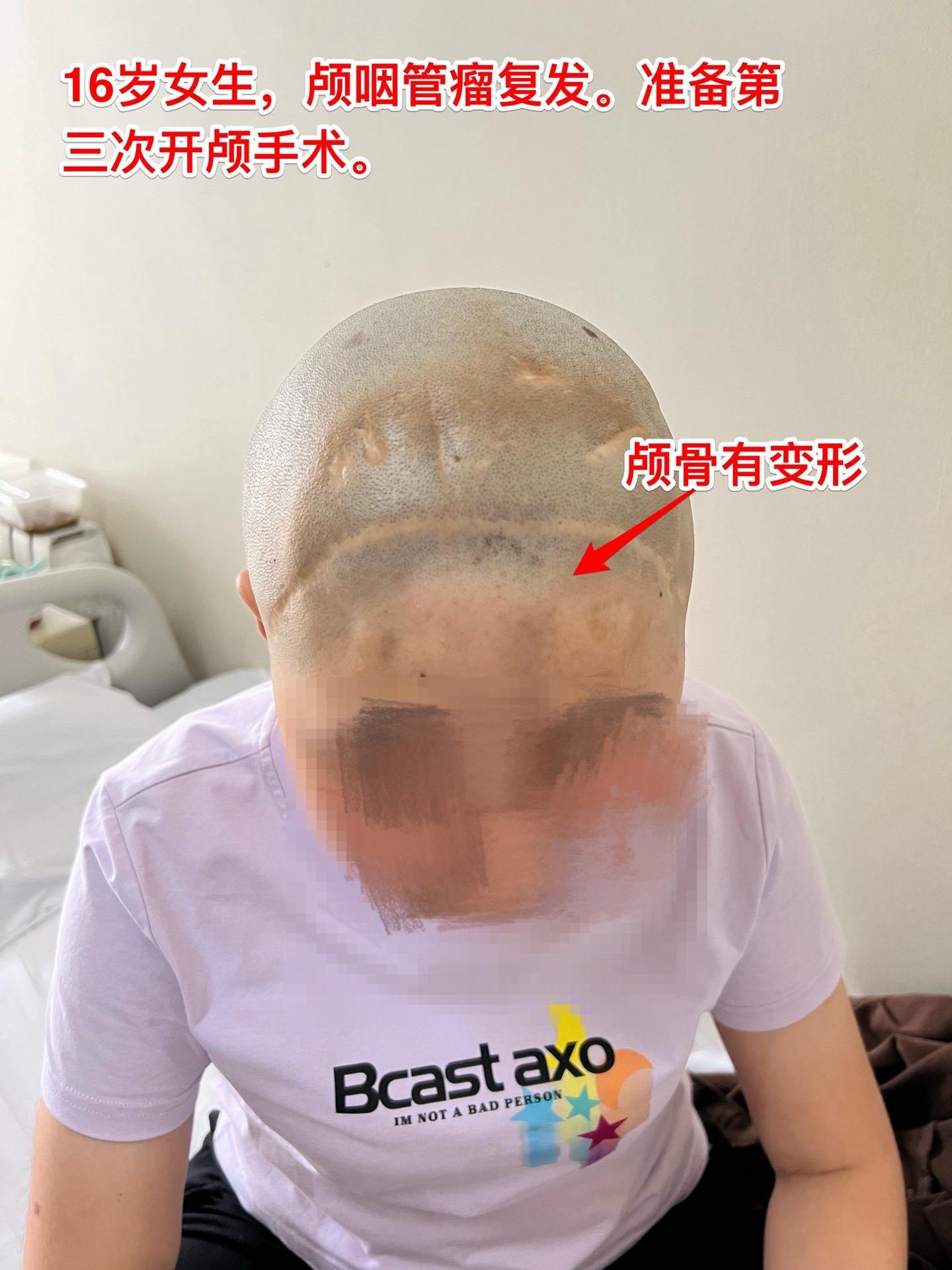 16岁女生颅咽管瘤第三次手术。第二次手术是在2013年1月。那次手术后还因脑积水作了脑室腹腔分流术。出院后能上学读书，而且内分泌方面还不错。有点遗憾的是额部手术疤痕及颅骨变形影响了病人的容貌。
         这次的手术原计划在5月28日进行，因为她的生理周期突然提前了（自然的周期）故而将手术推迟到6月4日进行。肿瘤得到完全切除。
        这次的肿瘤体积很大，但是还没有影响到垂体-下丘脑，可以预见，她的内分泌功能不会受到破坏。只希望她的肿瘤不再复发。内分泌