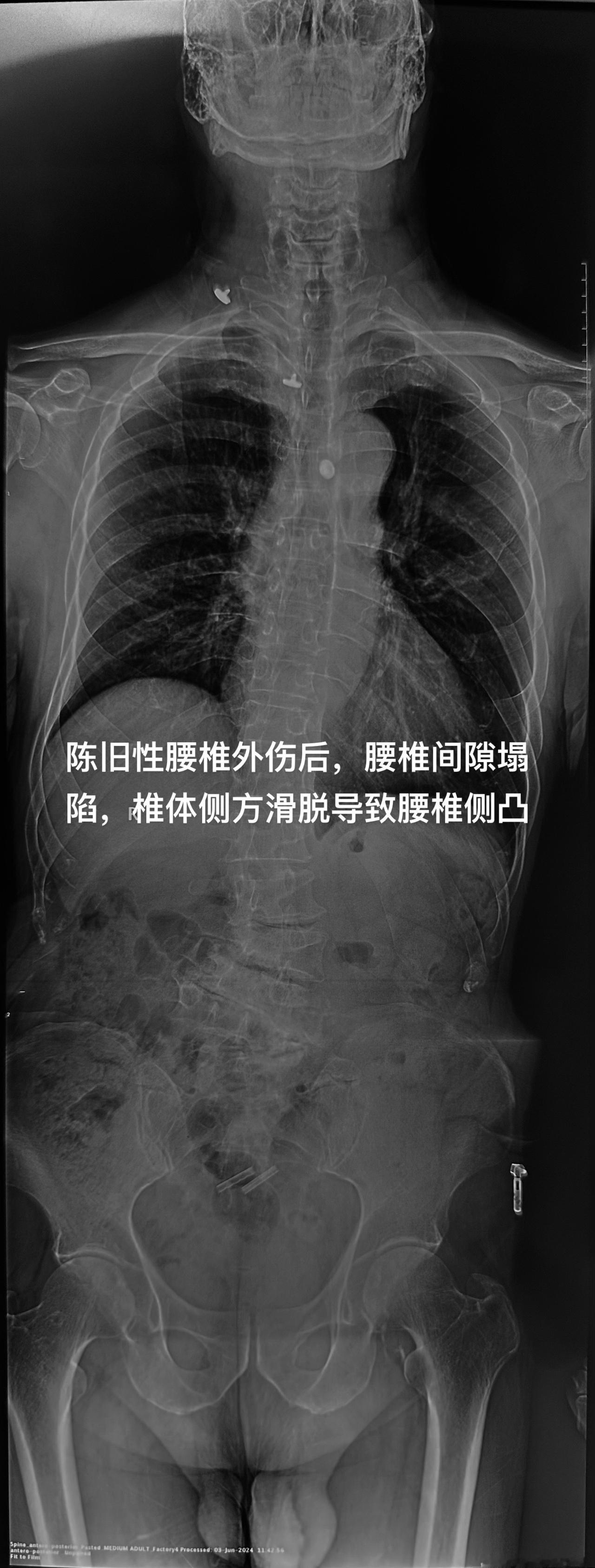 有点挑战难度的腰椎退变侧凸