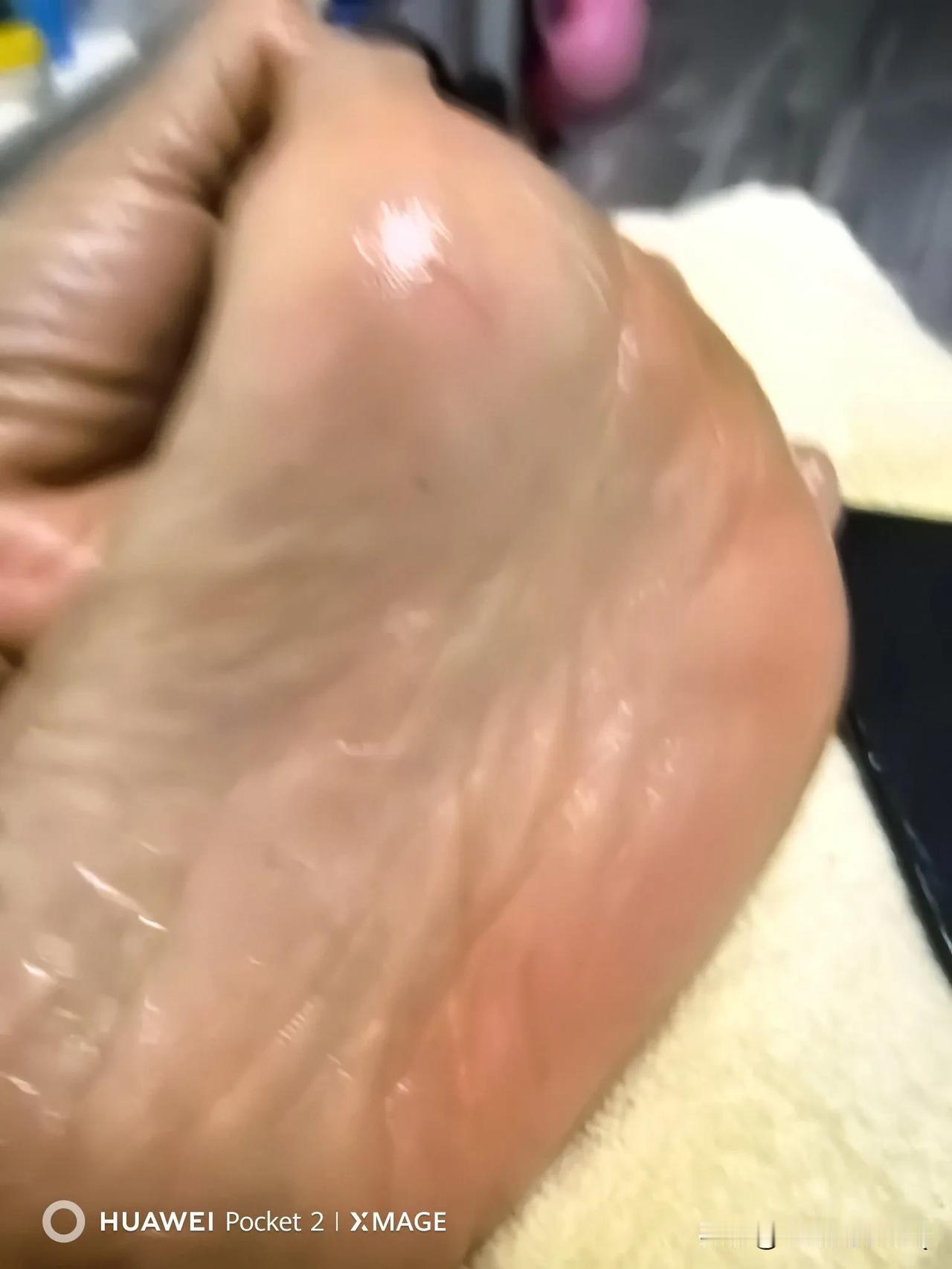 刮脚筋二十天左右，睡眠没感觉多好，但是，脚底和脚面的皮肤好看多了。今天左脚居然刮