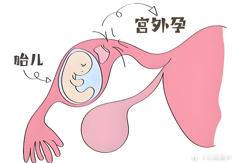 体内射精后吃了紧急避孕药，为什么却宫外孕了？分享一个咨询，说她男朋友一开始想要同