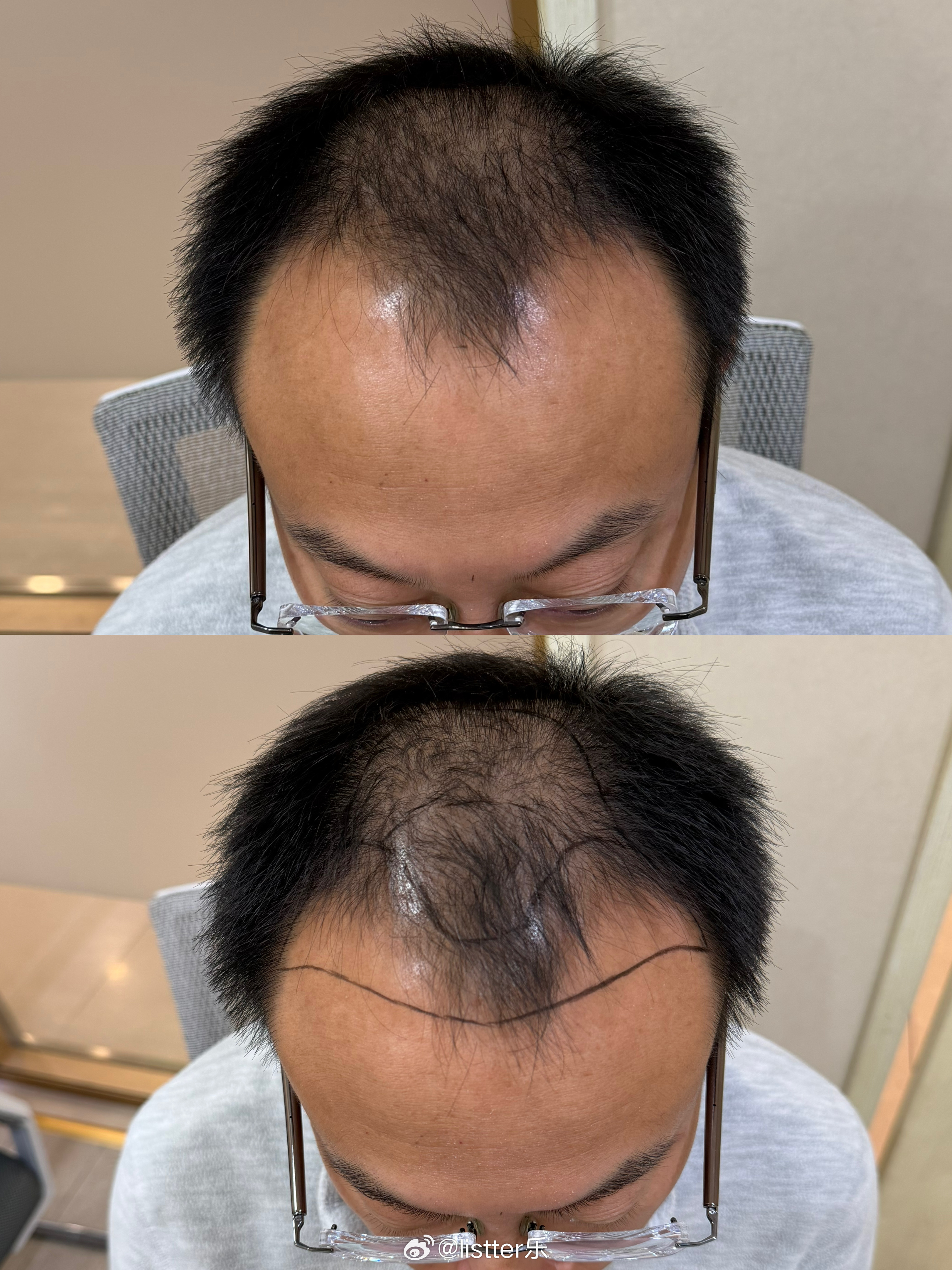 现在的技术真厉害，上周六临时起意做了个不剃发植发，不影响周一正常上班，七天后就能