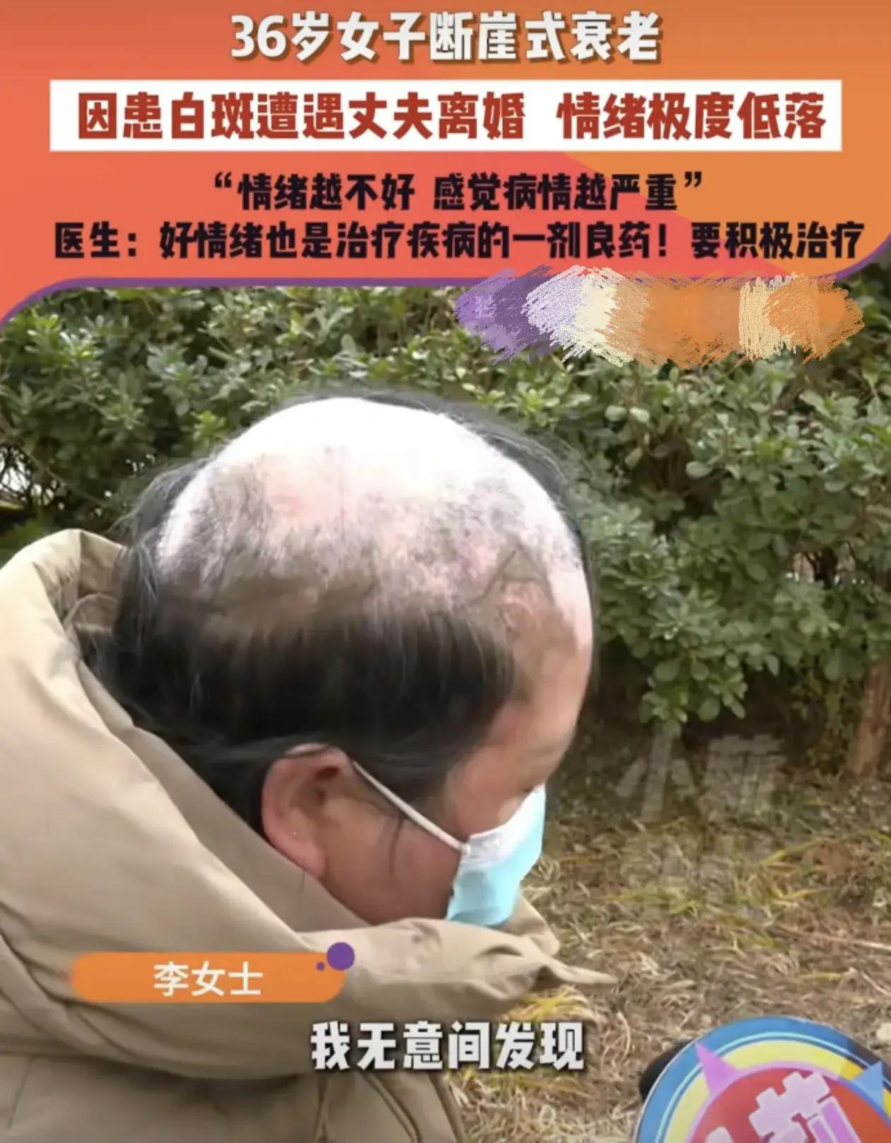 震撼心灵的真实故事：36岁白癜风患者的苦难人生，婚姻不是避风港，独立才是真正的救