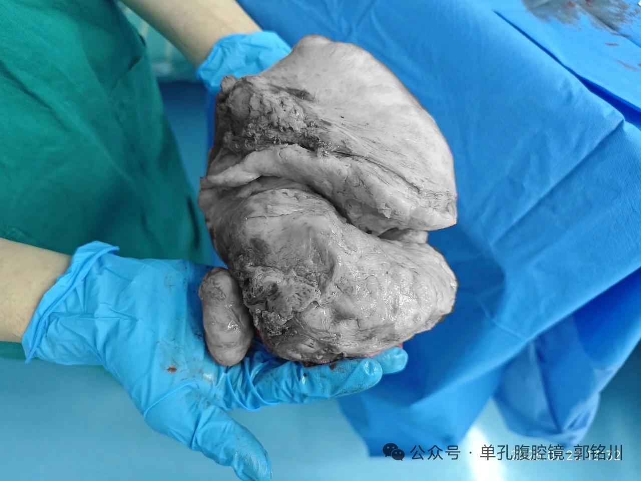 不说的话，谁能想到，这是18.5厘米大的子宫肌瘤……咋这个颜色 