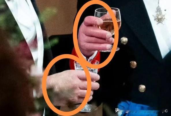 一个像胡萝卜，一个像紫茄子……英国国宴上，媒体注意到，查尔斯的手依然很红肿，特朗
