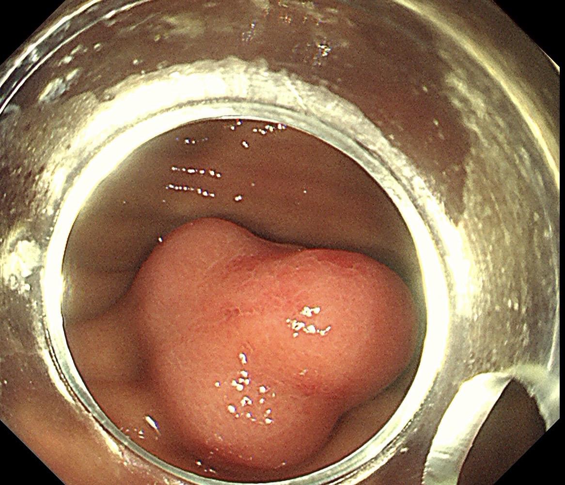 双牙线牵引辅助缝合，我们科大二附院内镜中心的小创意！ 胃体上部大弯侧近...