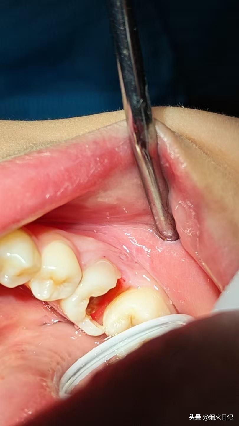 6岁孩子的牙齿就被‘虫子’吃光了，究竟什么原因造成的呢？

姐姐一家人可以说隔三