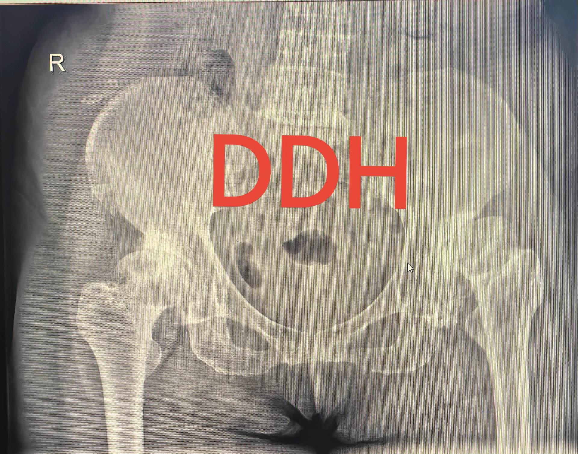 DDH，髋关节置换，髋关节发育不良。DDH髋关节置换，术前备的垫块，术...