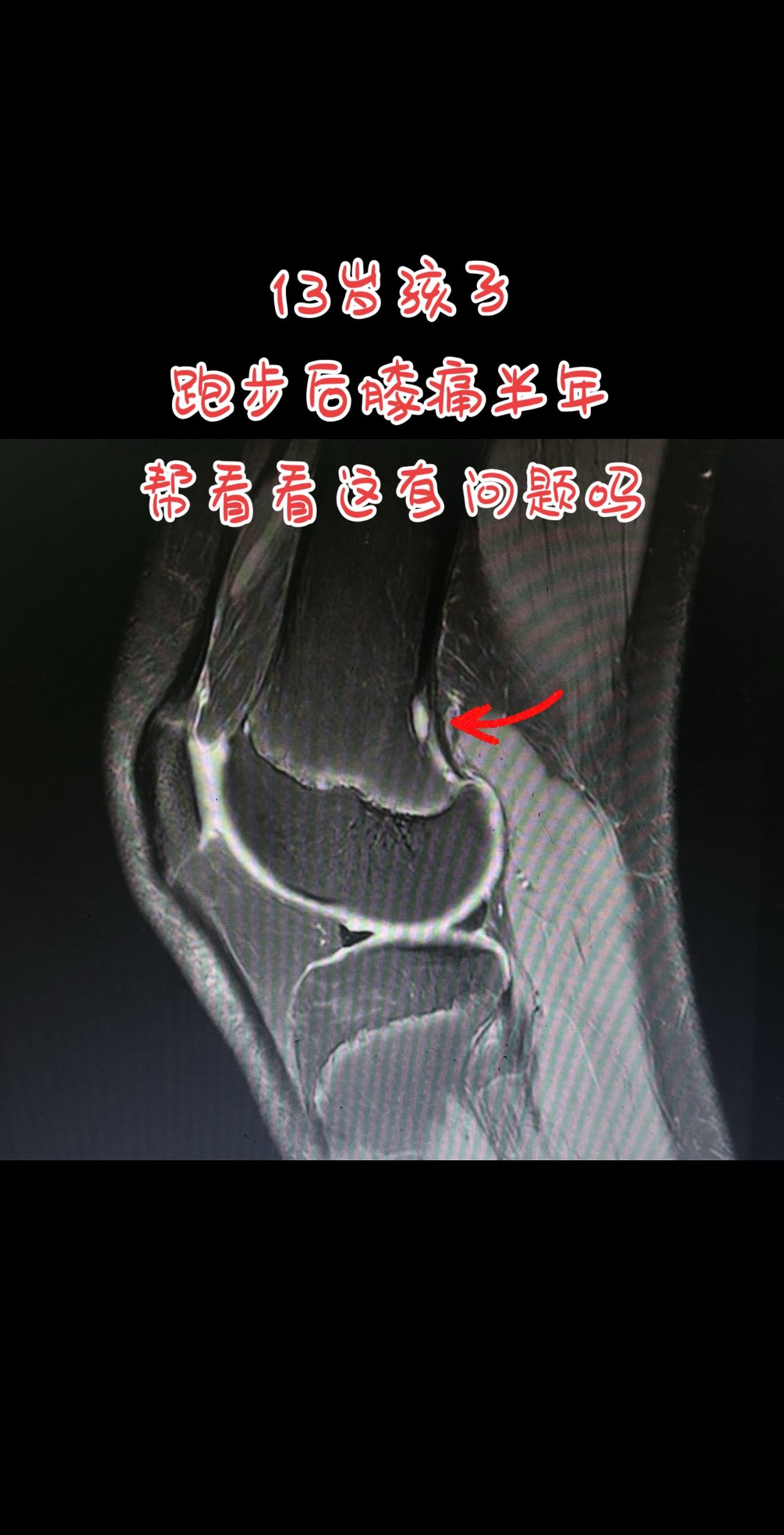 13岁孩子核磁有问题吗。这个核磁是什么问题呢