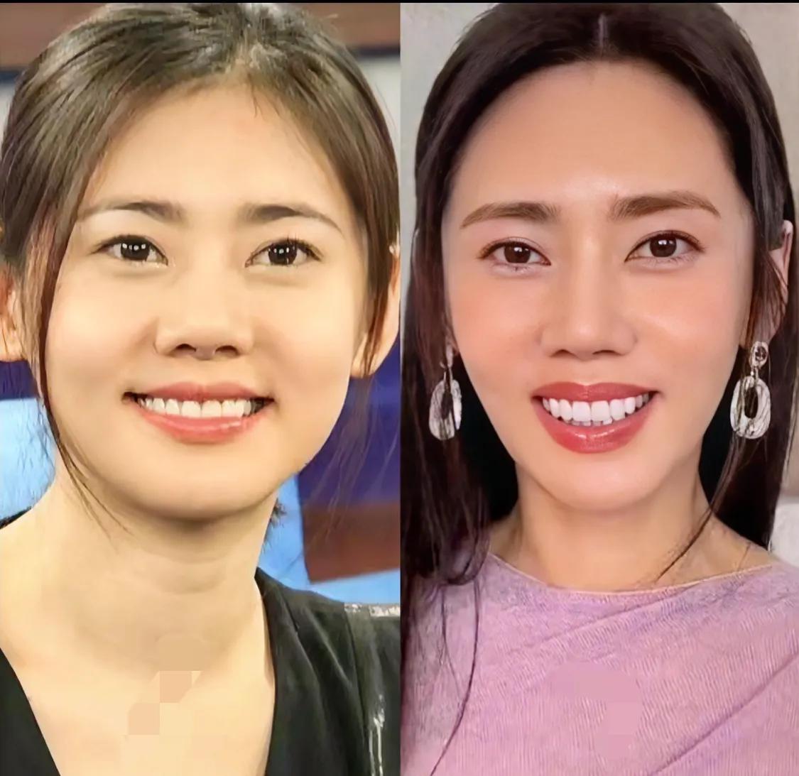 年龄大了牙床也会变吗，不过我觉得妆容灯光不合适罢了 美颜开的把脸修瘦了显得哪哪都