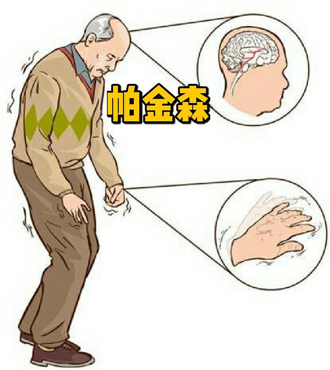 绝了！
进博会脑机接口落地，帕金森患者获新疗。
谁能想到“读脑治病”真的走进现实