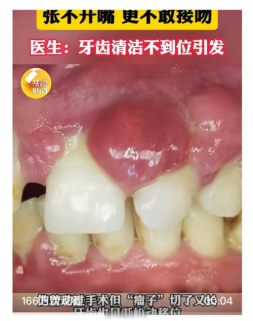 小伙刚结婚满嘴牙龈瘤不敢接吻现在很多医院里的医生还是挺没基本常识的，只知道“哎呦
