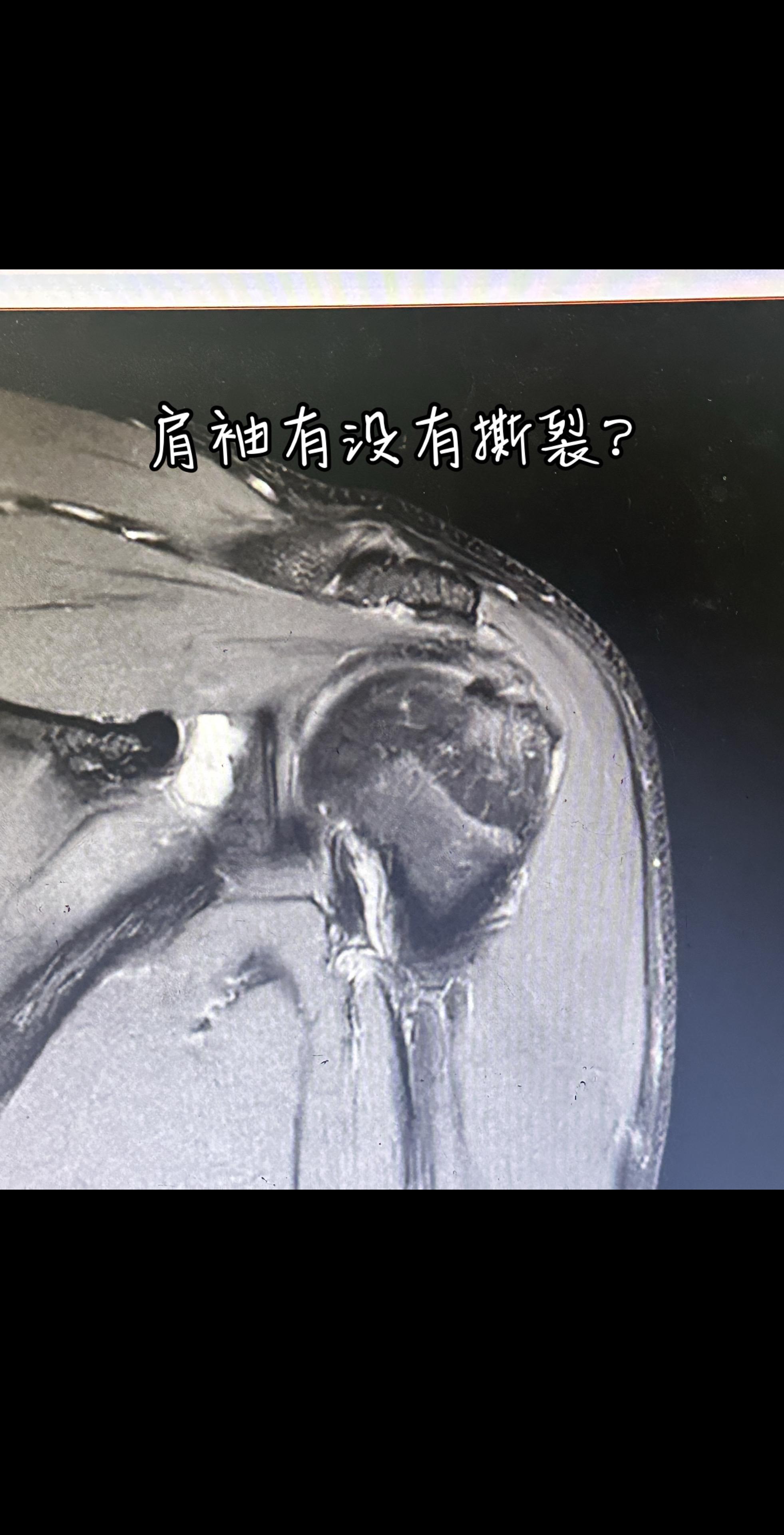 看看这个肩关节核磁有什么问题。大家一起来找茬