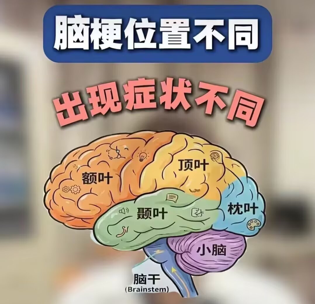 9002【脑梗位置不同，症状千差万别】1:顶叶梗死，可表现为对侧肢体感觉障碍（如