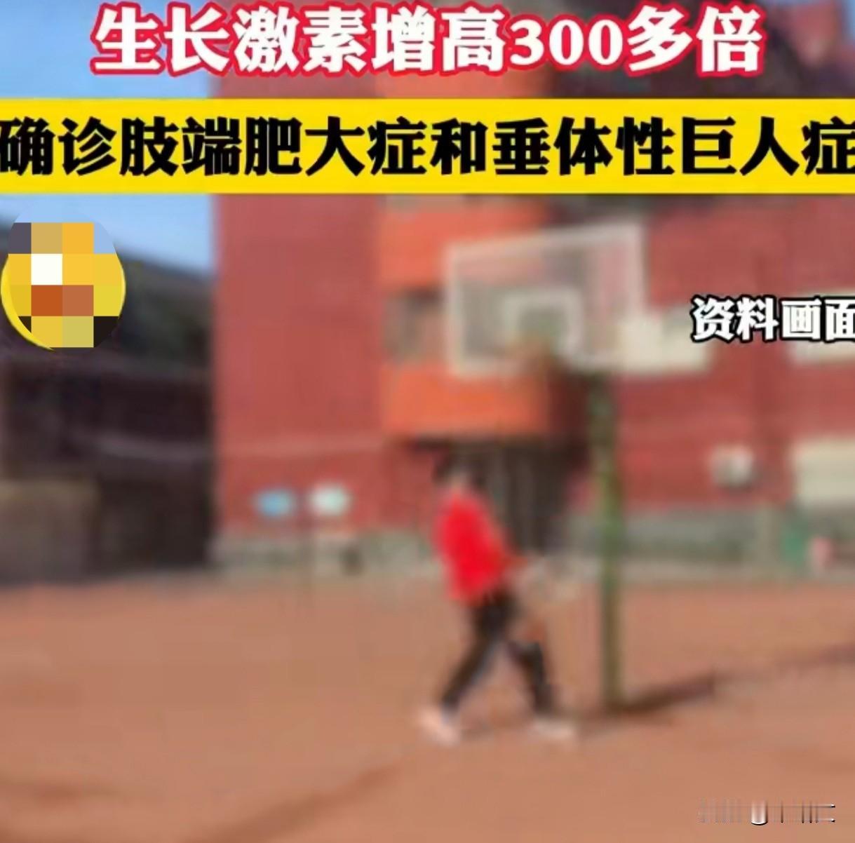 20岁小伙1年猛长25厘米，身高2米23，竟查出三种病！
 
浙江温州20岁的小