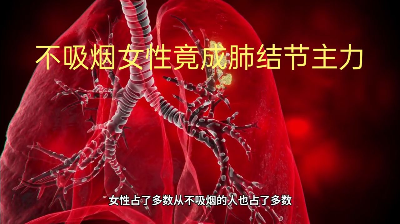 钟南山团队万例数据：不吸烟女性竟成肺结节主力。