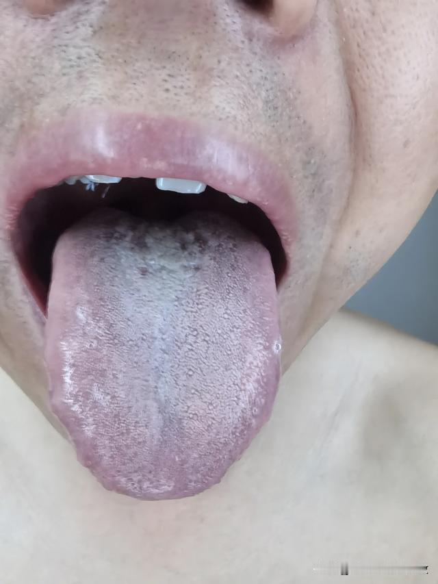 舌苔白成这样，还在拖，真不知道你在想啥，再拖下去肯定血瘀跑不了[狗头][狗头][