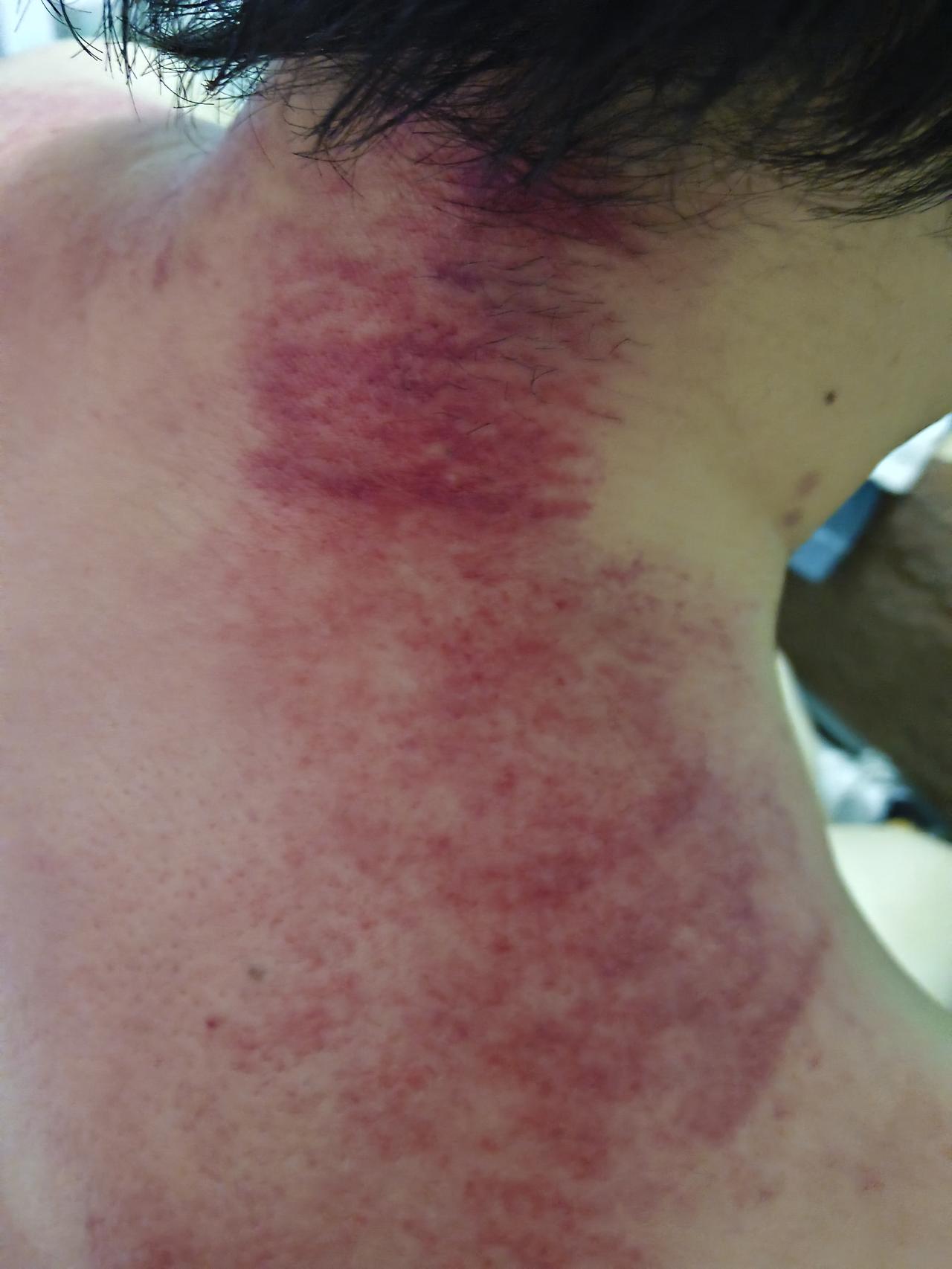 大姐一直说脖子疼，都这样了，你说能不脖子疼，我一边刮痧，她一边躲，不让碰，毛病都