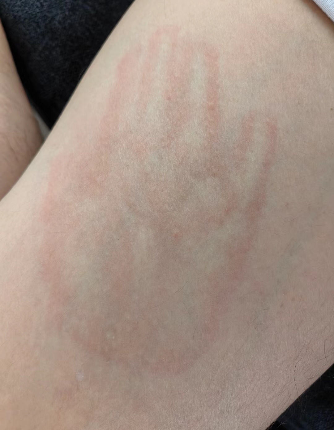 第一次见这么高清的巴掌印[哆啦A梦吃惊]来自一位学过自由搏击的小朋友 ​​​
