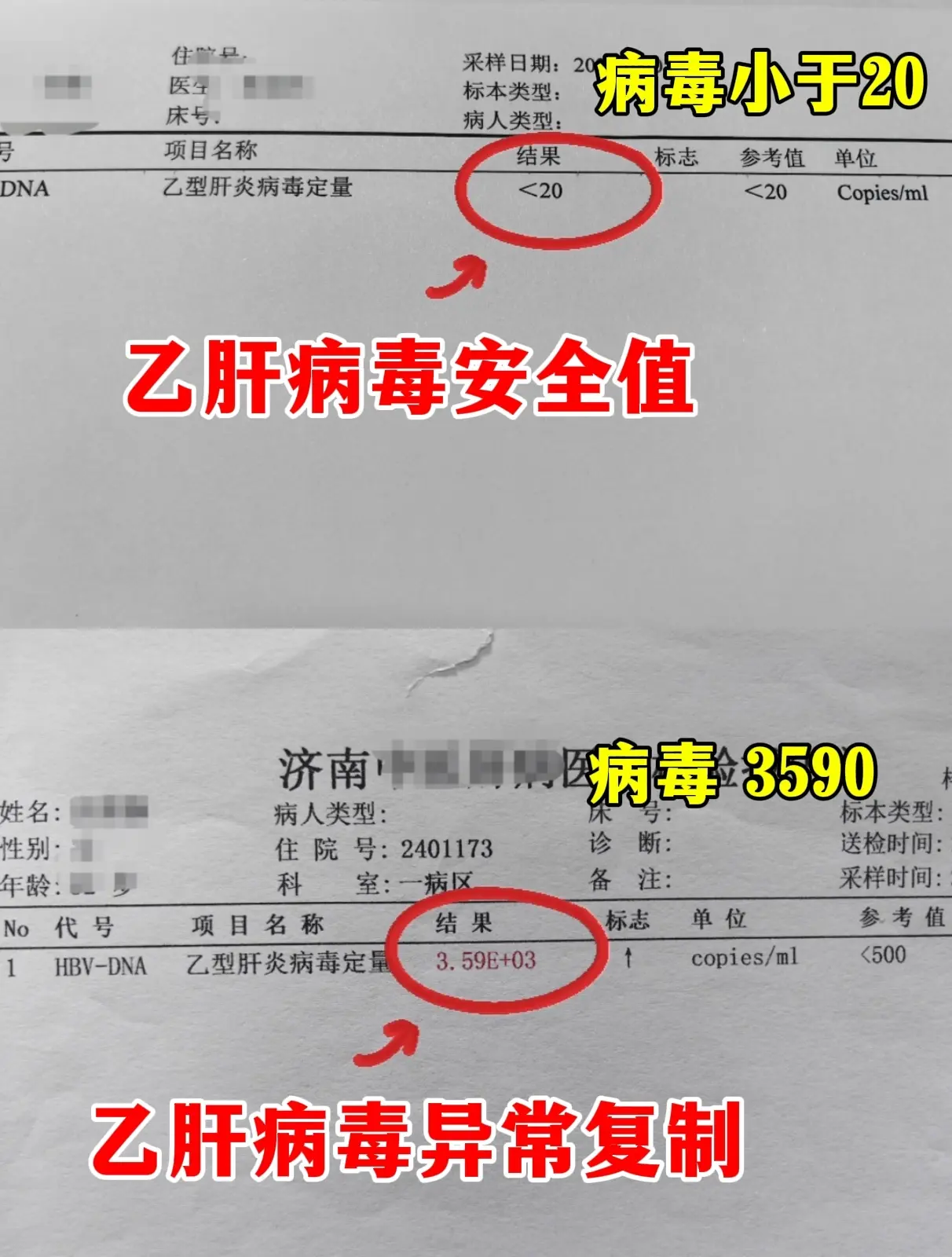 乙肝病毒低于这个标准，恭喜你 。病毒不再复制！ 1、病毒低于20或者1...