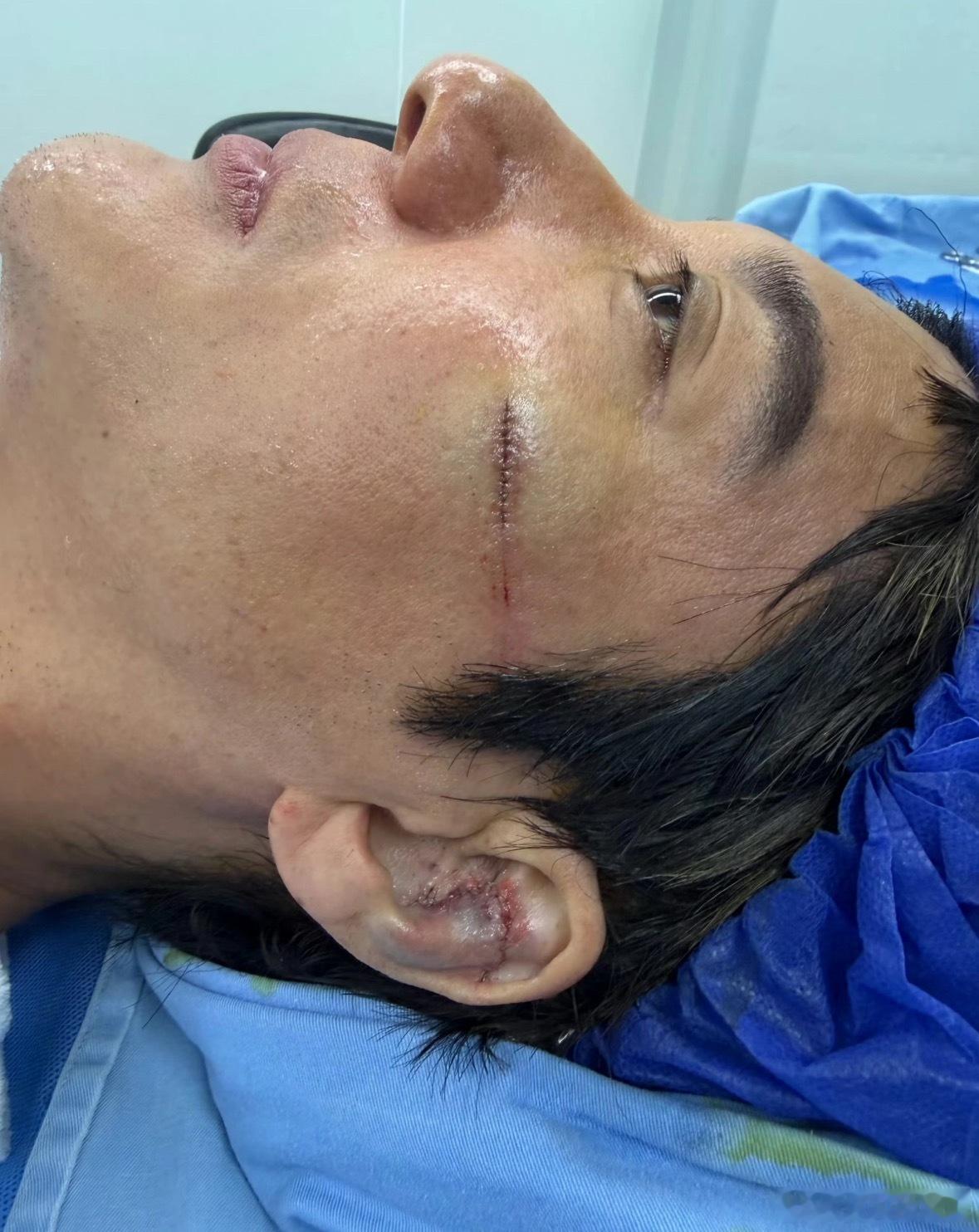 王力宏缝了39针 在流血的情况下硬生生撑完3小时演出，极致敬业。希望歌手以后可以