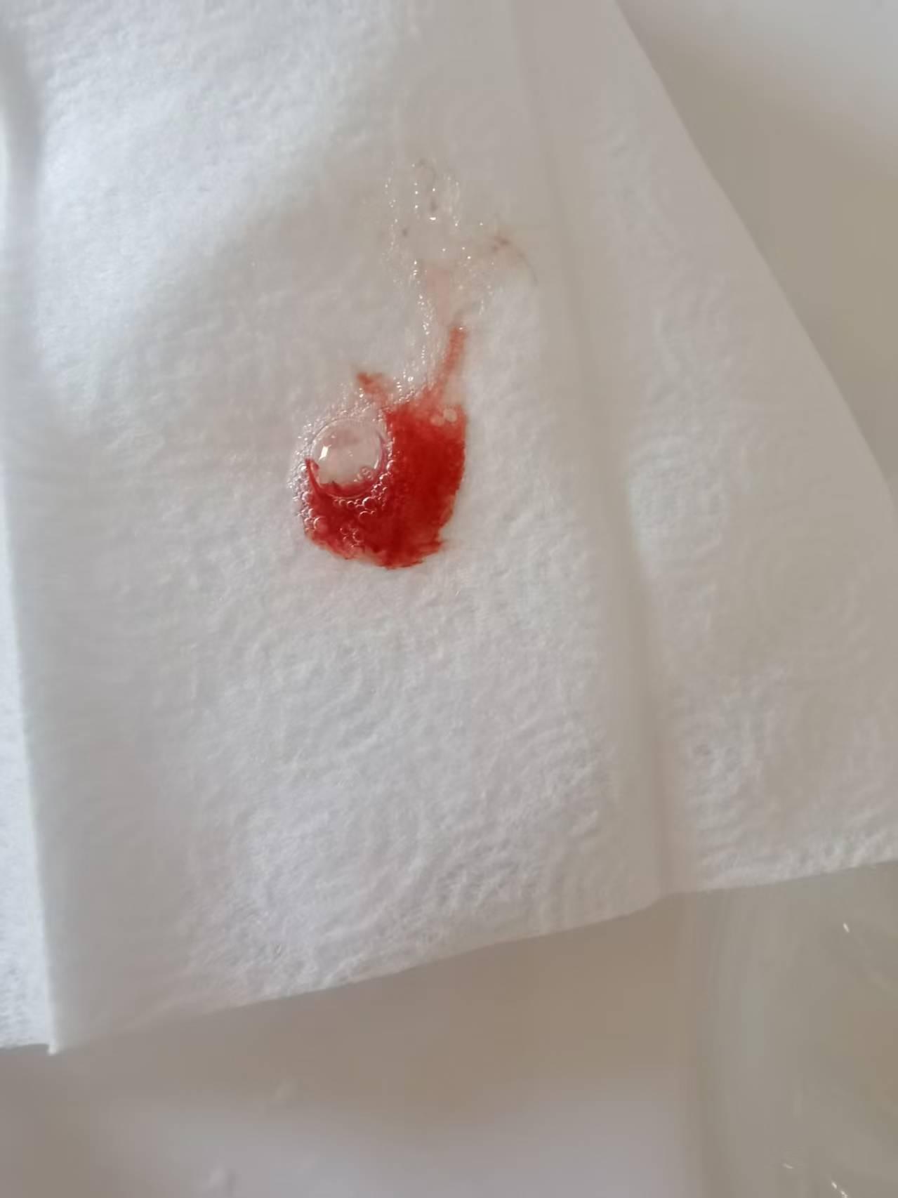 【看看检查结果这是死不了啦吧】
2025年12月24号，因为口吐血去做了一个检查