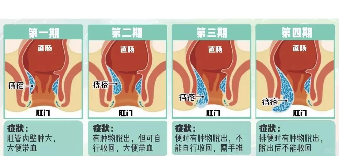 你的痔疮几度了？