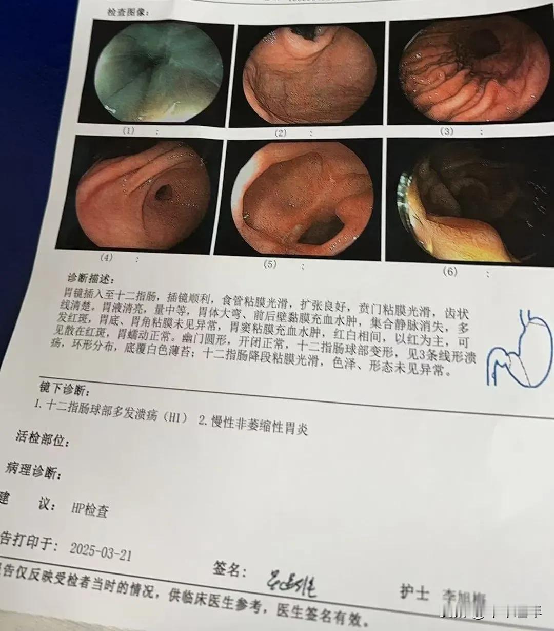 逆转萎缩性胃炎需做好的四件事

1. 优先根除幽门螺杆菌（Hp）

约70%的萎