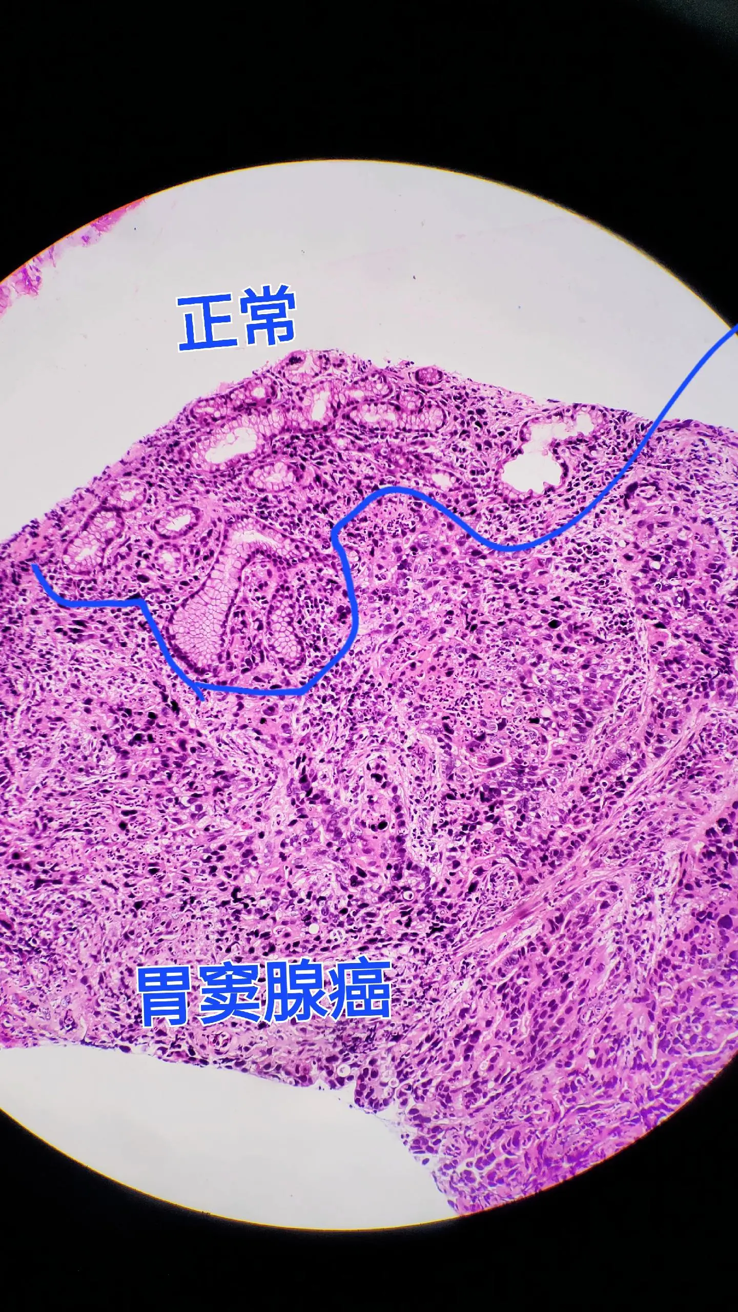 胃腺癌