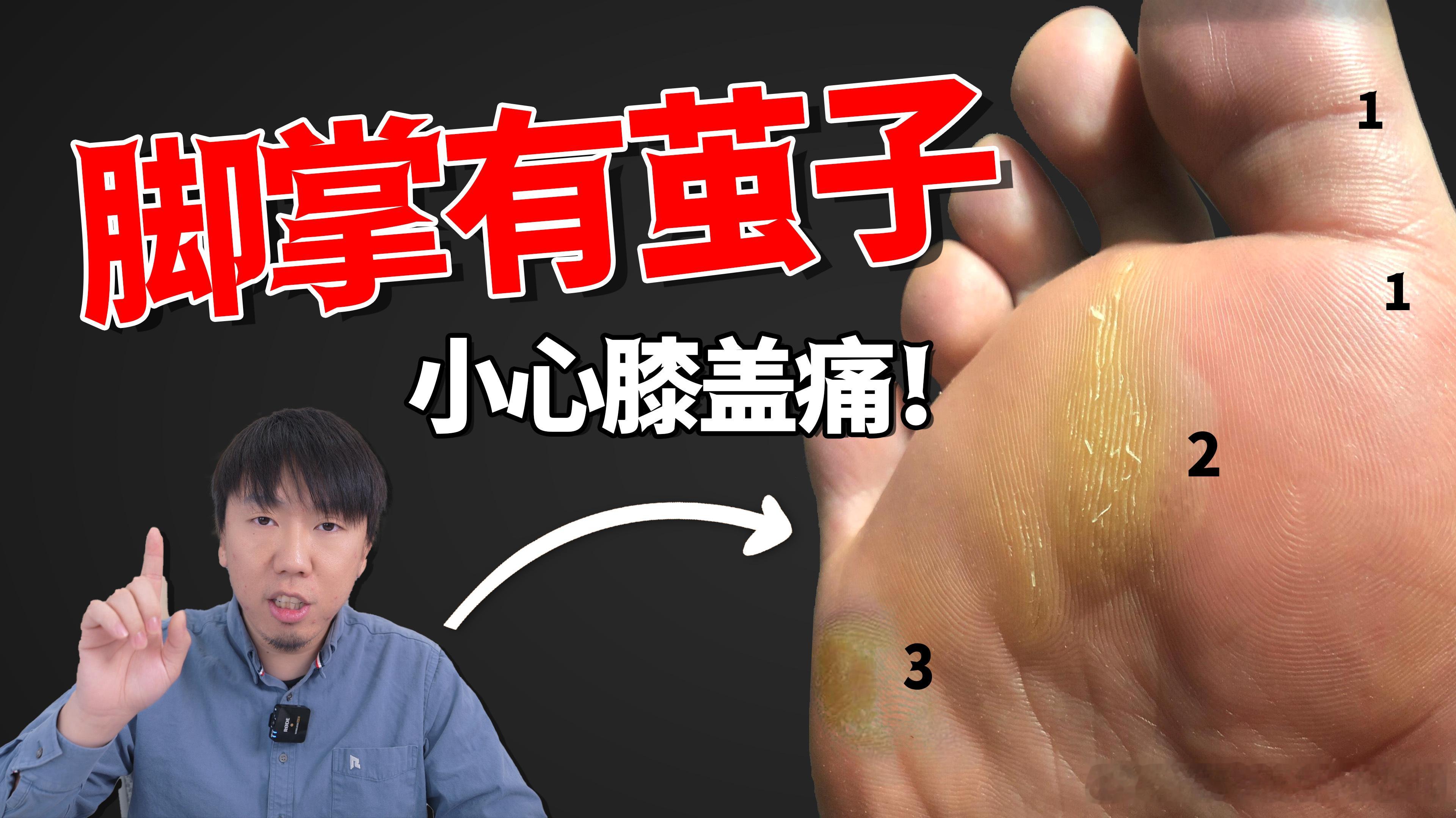 来来来，做个小调查——你的脚底，有没有容易长茧子的地方，又是1.2.3哪个位置[