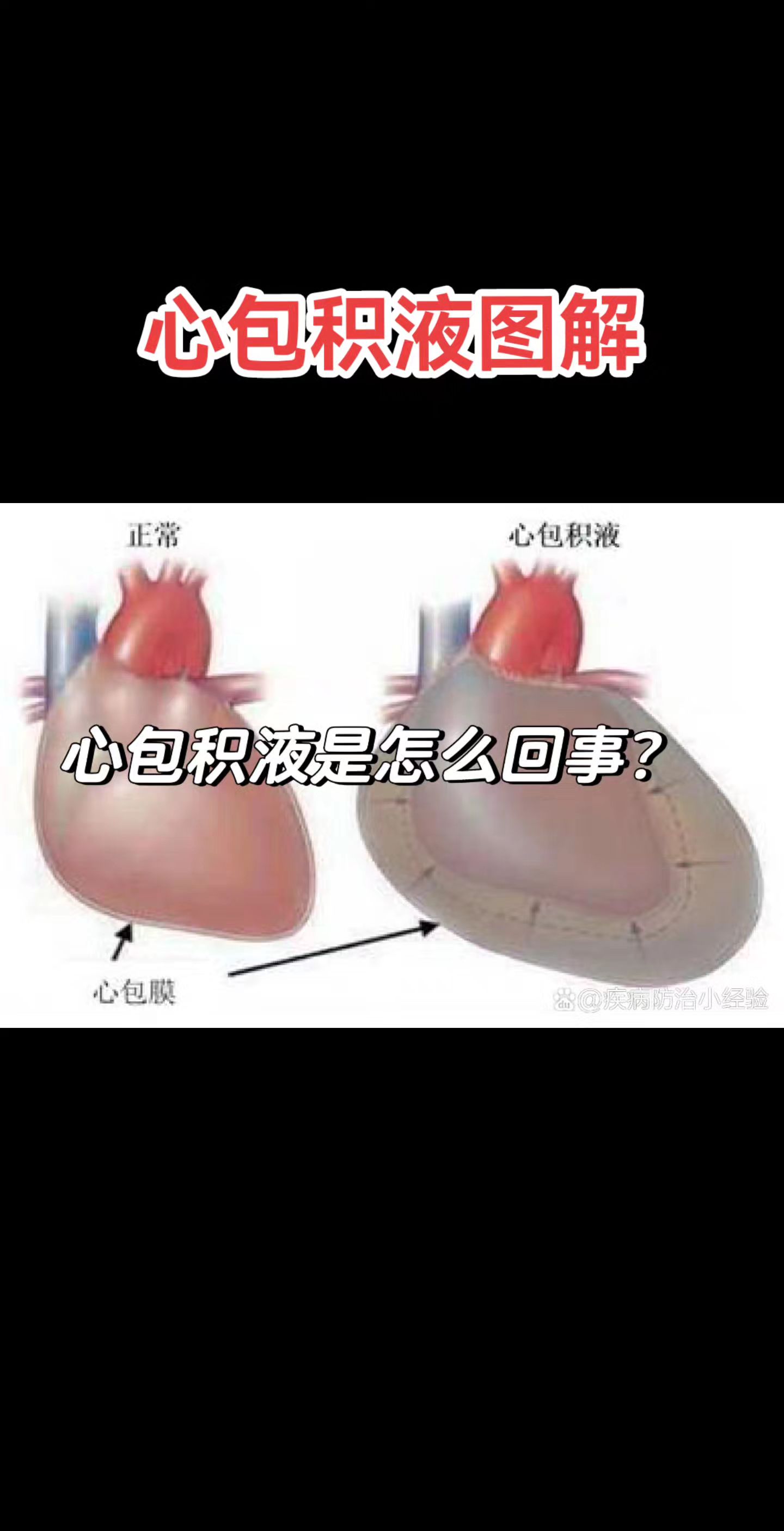 心包积液。