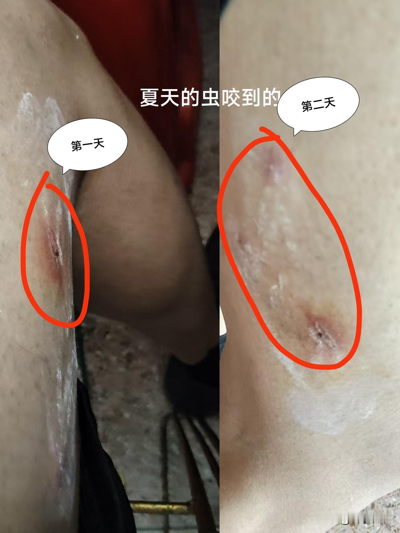 夏天户外活动注意了，能穿长裤尽量不要穿裙子或短裤，蚊子虫子多，最可怕的莫过于皮肤