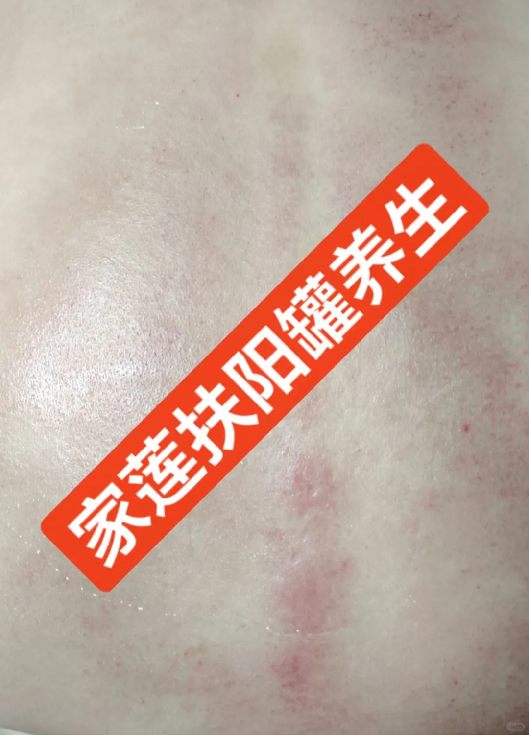 做扶阳罐调理身体，皮肤会越来越健康。​这