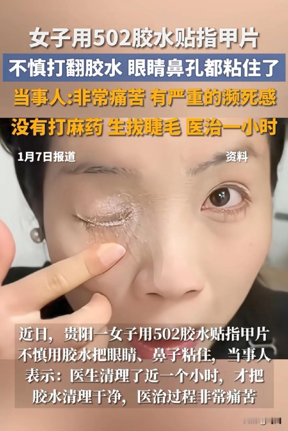 最担心的事还是发生了！
女子粘美甲时502胶水甩入眼鼻！
右眼皮被完全黏住，医生