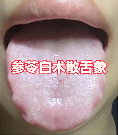 脾胃虚弱，参苓白术散，补中益气汤，木香顺气丸，到底怎么选，舌头不会骗人！


第