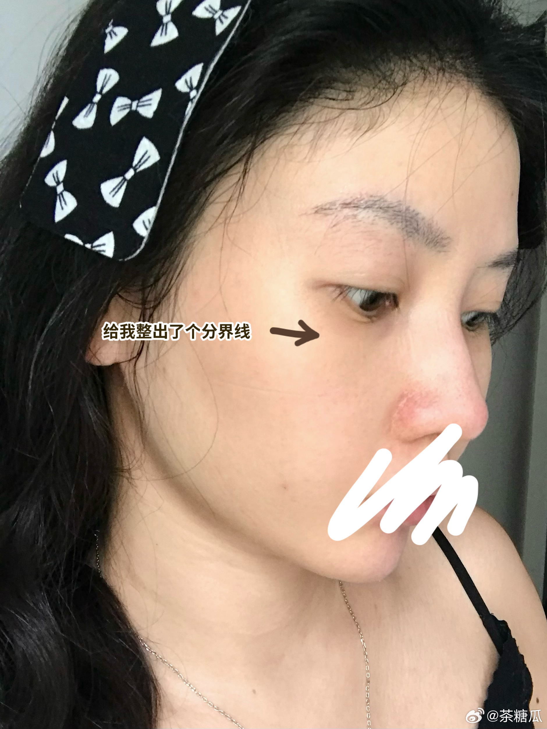 一照镜子我真的要笑死了，感受下来自发酵的权威！！眼下就一点没敷到，给我整出一道分
