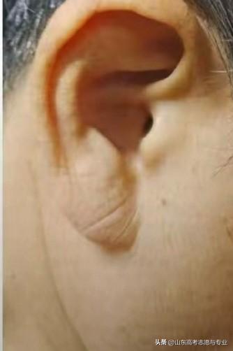 不好，耳垂上怎么有个沟？你们也有吗？
赶紧查了一下，有人说似乎和冠心病有点关系，