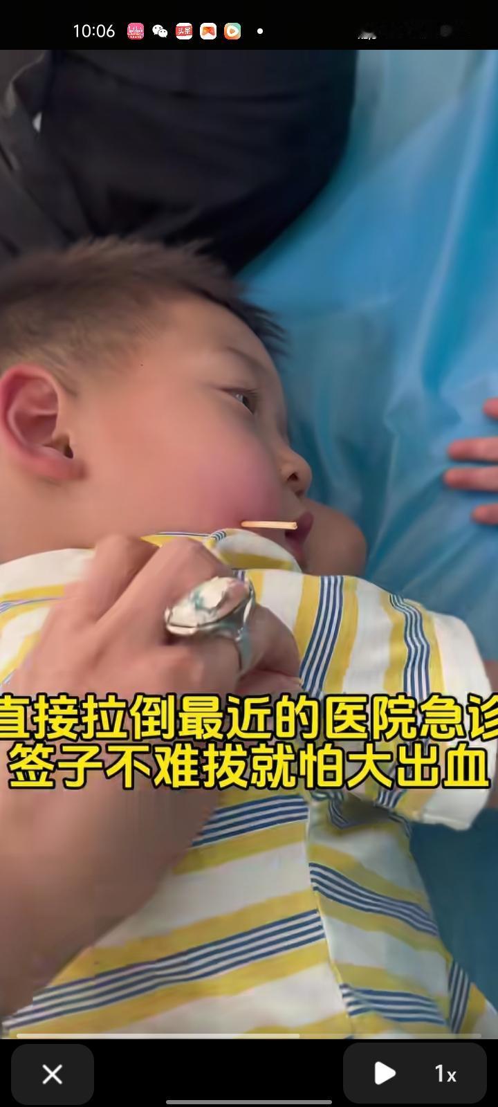 2月14日，西双版纳州景洪市。四岁半男孩在景区捡起地上的烤肠竹签，玩耍时不慎刺入