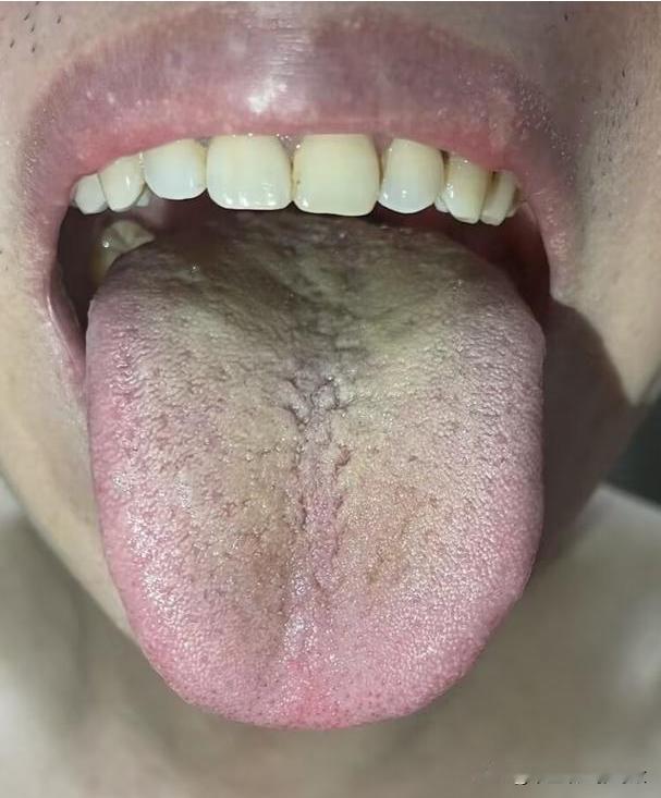 舌质发红，舌苔黄腻，凡是补肾的，一口都别吃了[黑线][黑线][黑线]

主诉：房