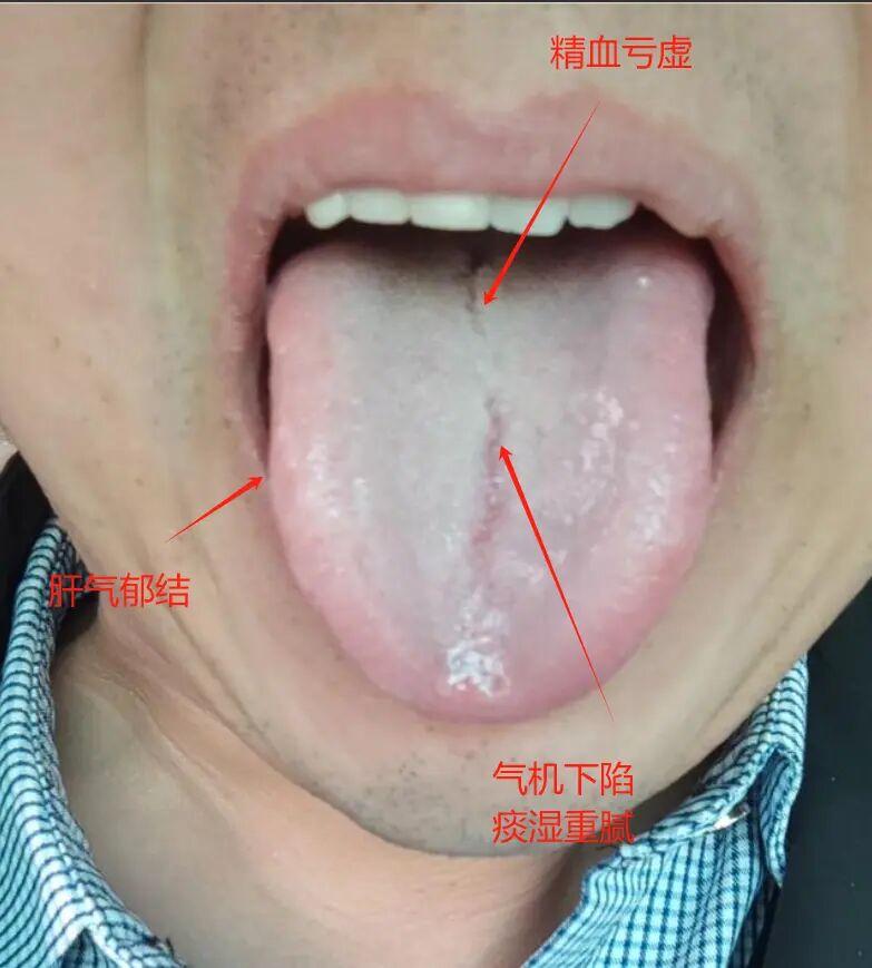 疏肝理气，化痰健脾，全面攻克脾肾阳虚难题！
对于脾肾阳虚和寒湿盛重的病症，如果只