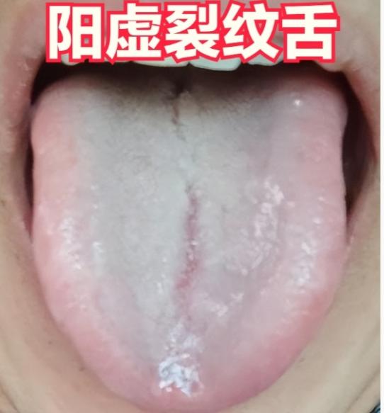 几张图，就能让你分清裂纹舌的病因，看一看你是哪一种？

🔍 阳虚裂纹舌
冬天湖