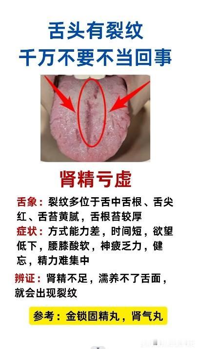 舌头上出现裂纹，你可千万不要不当一回事
分享4种裂纹舌，绝对有你
#中医##健康