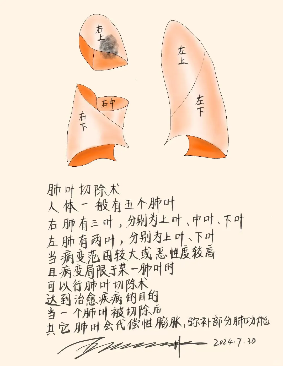 肺叶切除术