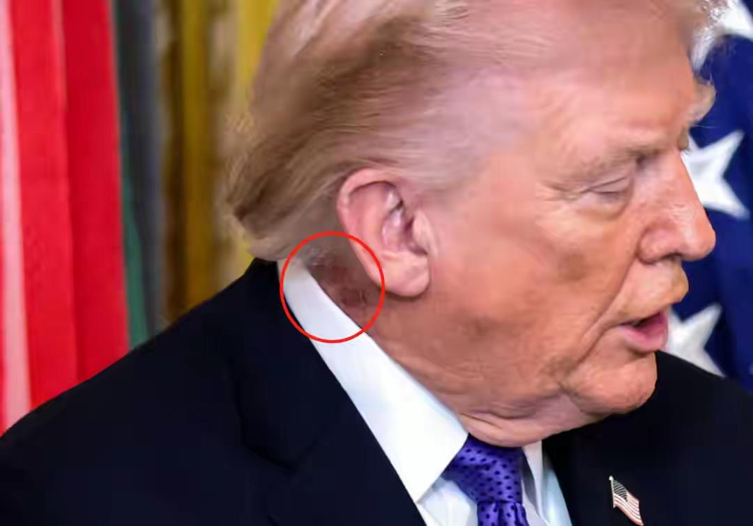特朗普脖子现红斑被曝治疗，近期他出席公开活动时，脖子右侧被拍到明显红斑印记，媒体